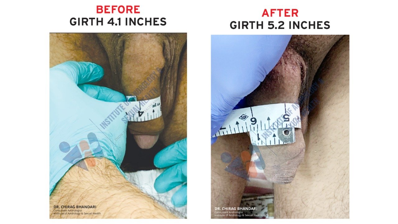 How To Increase Girth Size Surgery 18. 