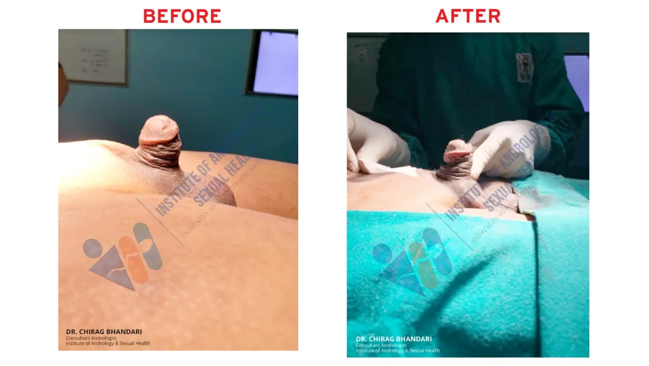 penis enlargement surgery in india