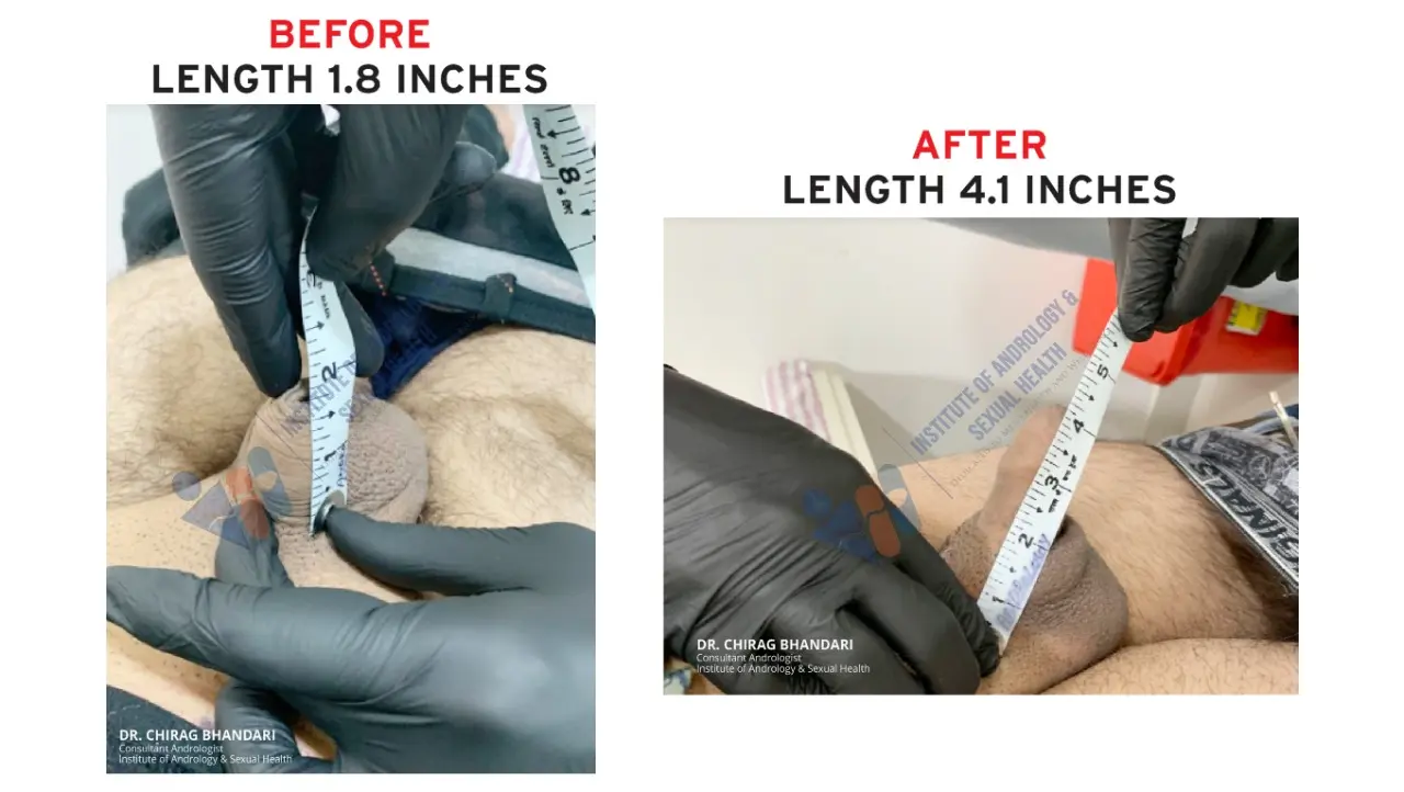 before & after penis enlargement in india