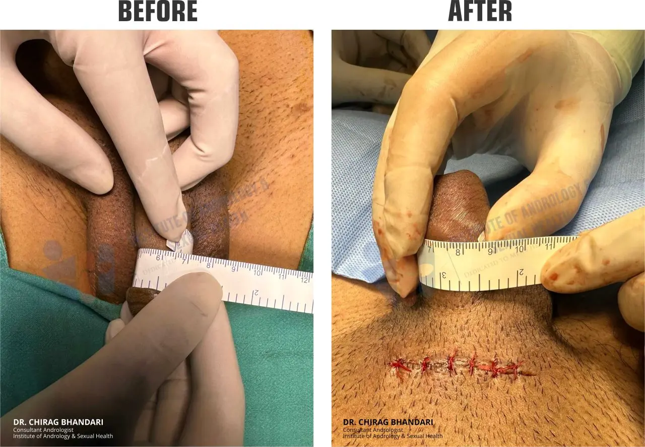 Penis enlargement surgery before and after 2