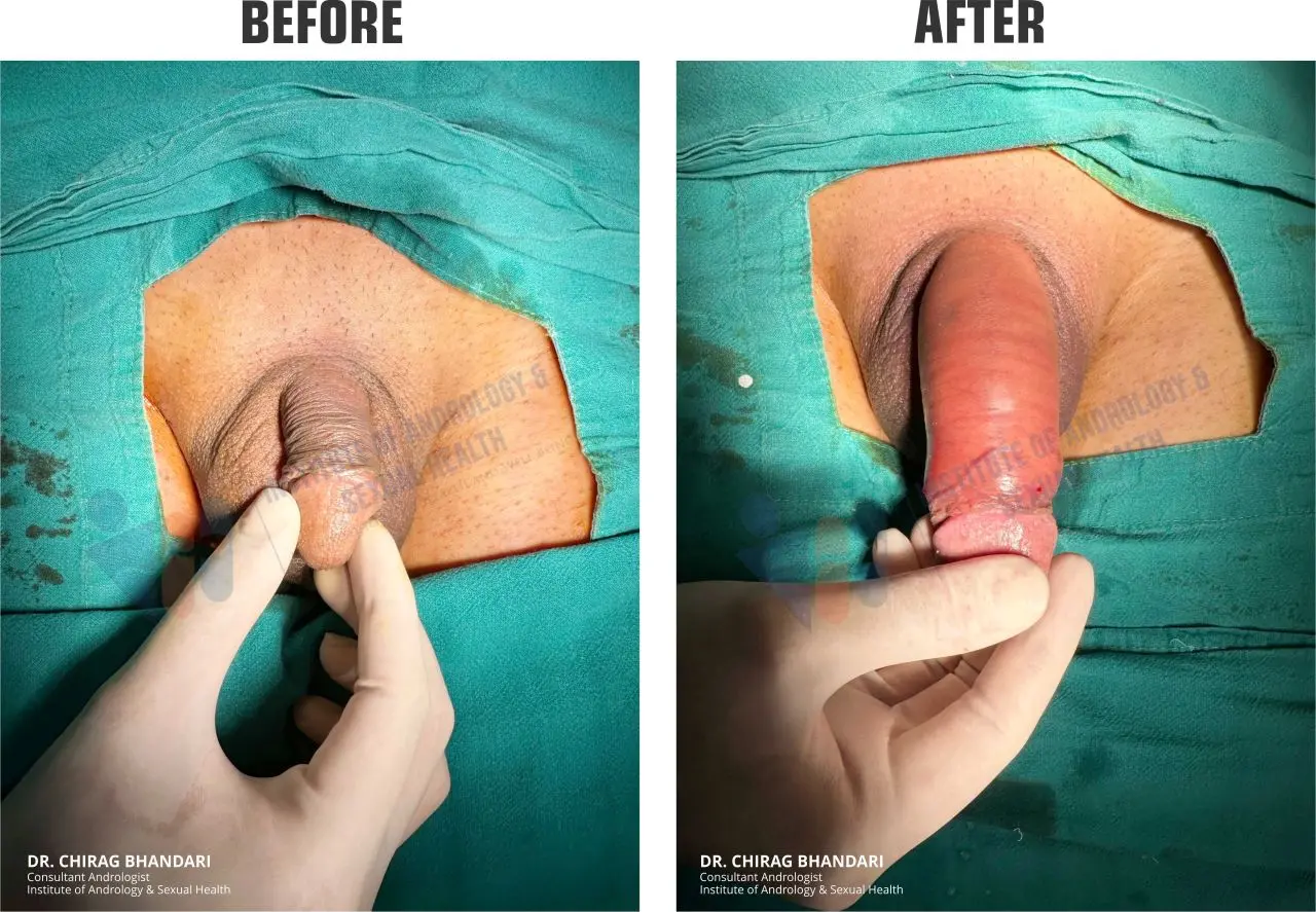 penis enlargement surgery before and after 3