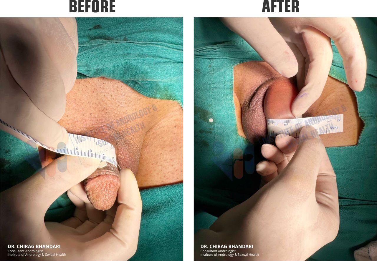 penis enlargement surgery before and after 4